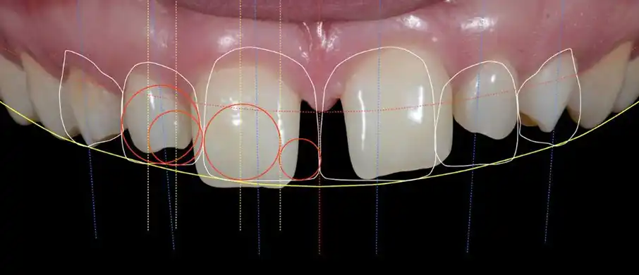 طراحی لبخند در کرج