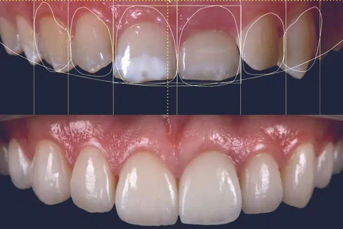 طراحی لبخند دندان